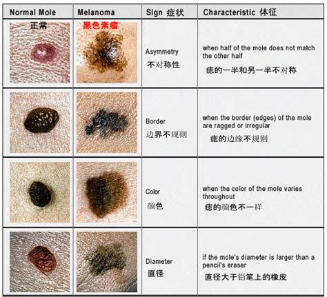 背部很多痣|你身上的痣会癌变吗？医生分析了100多颗黑痣，快来。